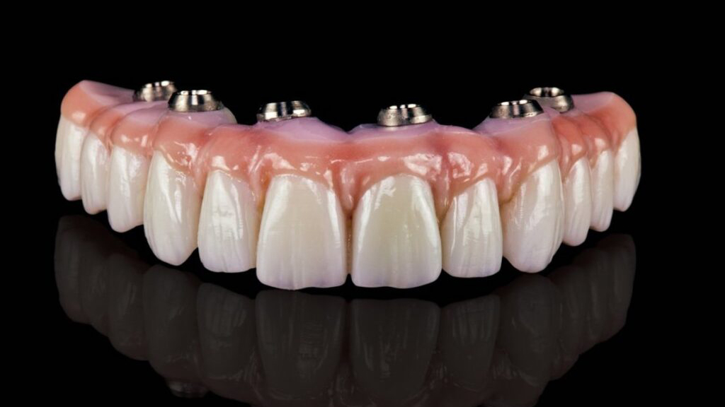 All-on-4 Implants: How Long does it last?