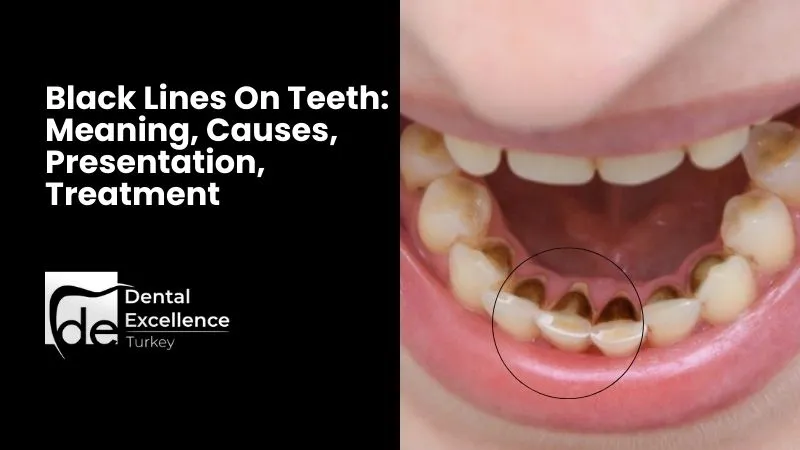 Black Lines On Teeth: Meaning, Causes, Presentation, Treatment
