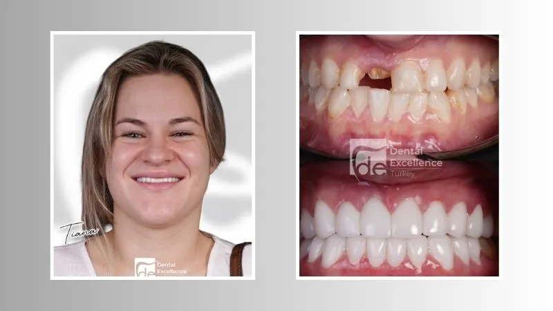 What Do Dental Implants Look Like?
