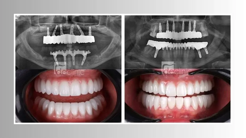  Dental implants appereance  