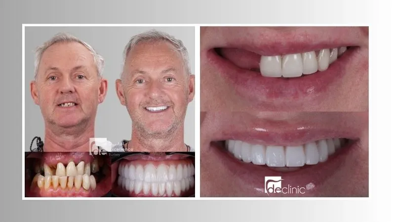  Dental implants before after Antalya  