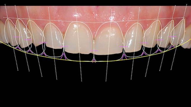 Benefits of Digital Smile Design