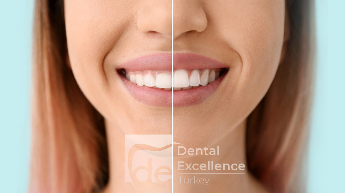 End Gummy Smile Problem with Botox!