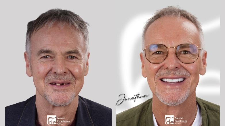 How to heal faster after dental implants?