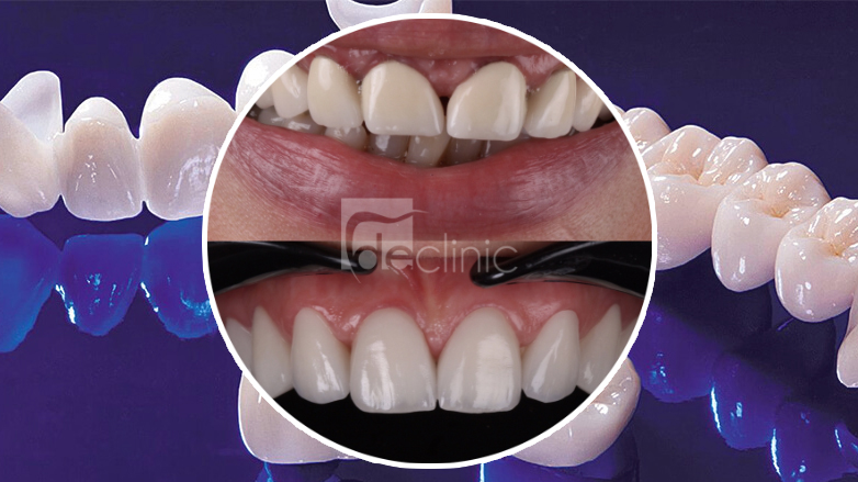   perfect smile with emax crown 