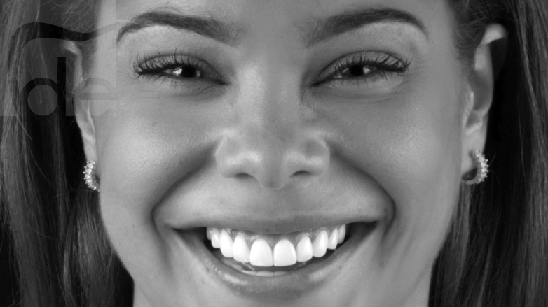 Get the Perfect Smile with E-Max® Crowns