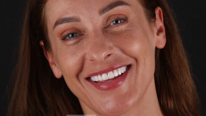 Porcelain Veneers for Crooked Teeth