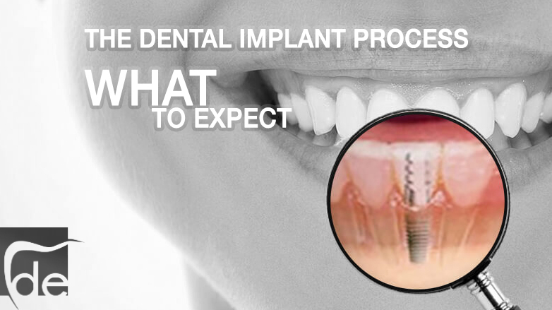 The Dental Implant Process: What to Expect