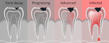   Tooth Decay Treated 