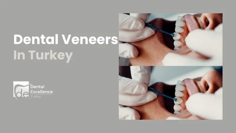 crown-vs-veneer  