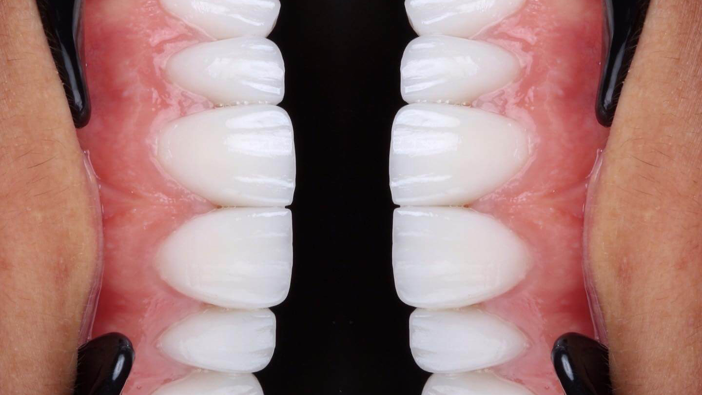 Veneers in Turkey
