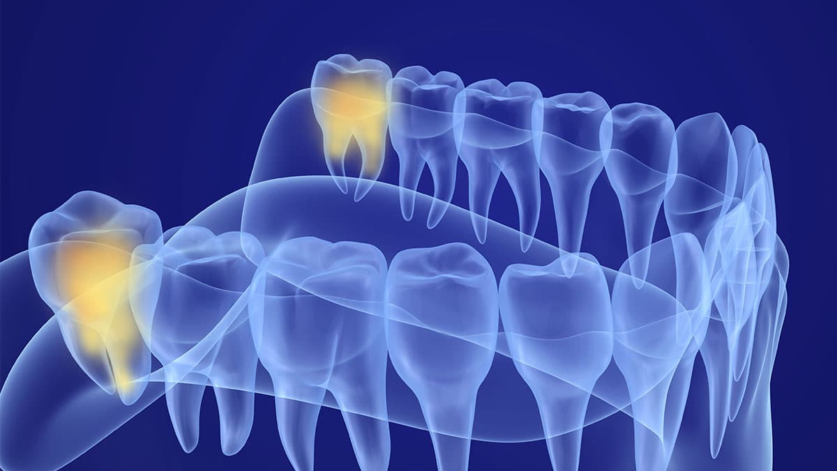  wisdom teeth removal  