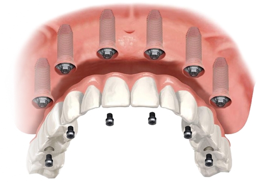 implant-operation  