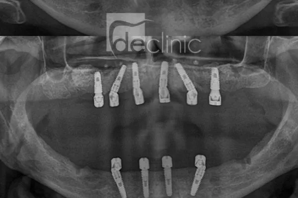 implant-operation  