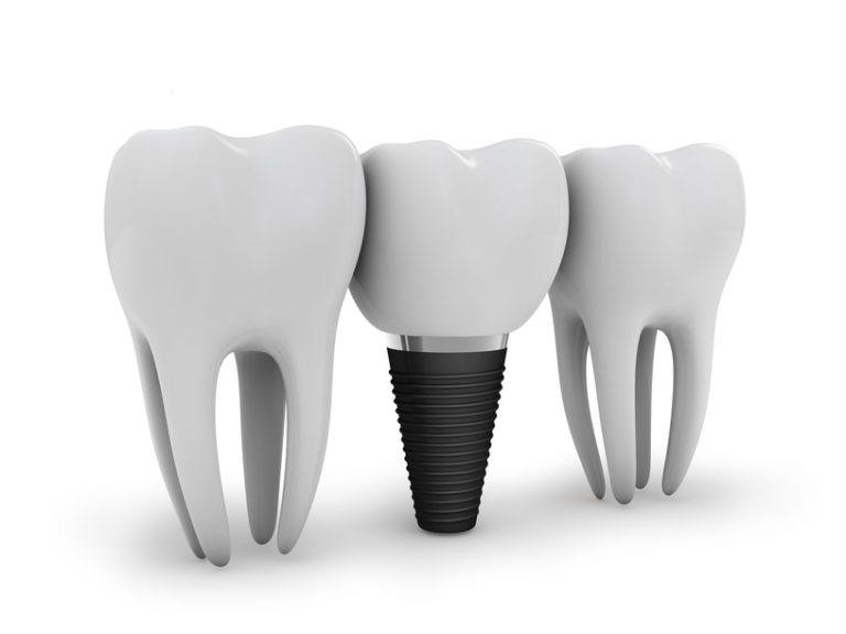 implant-operation  