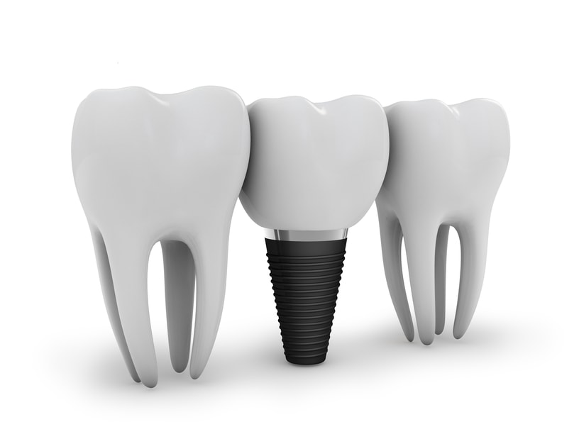 implant-operation  