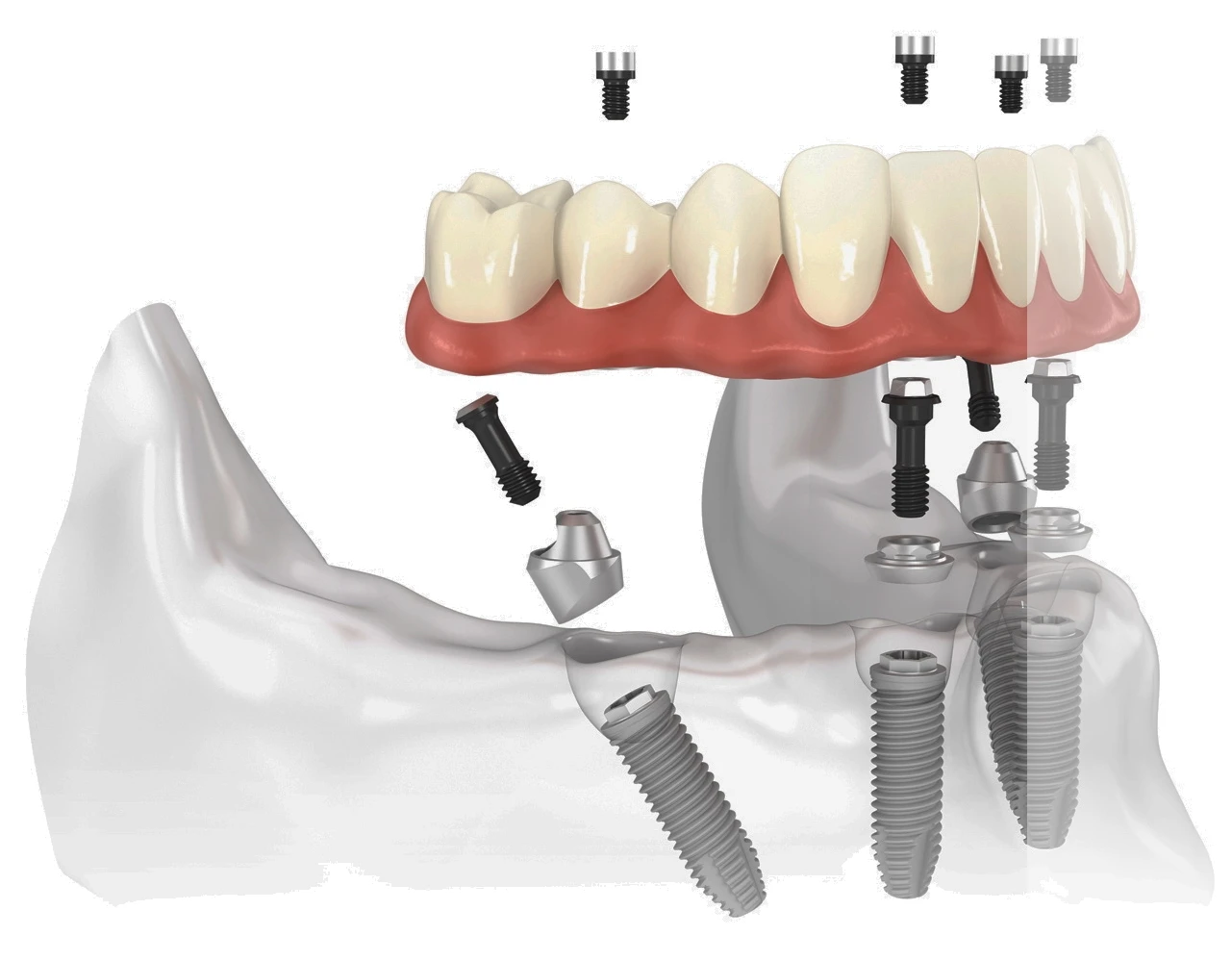 implant-operation
