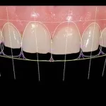implant-operation
