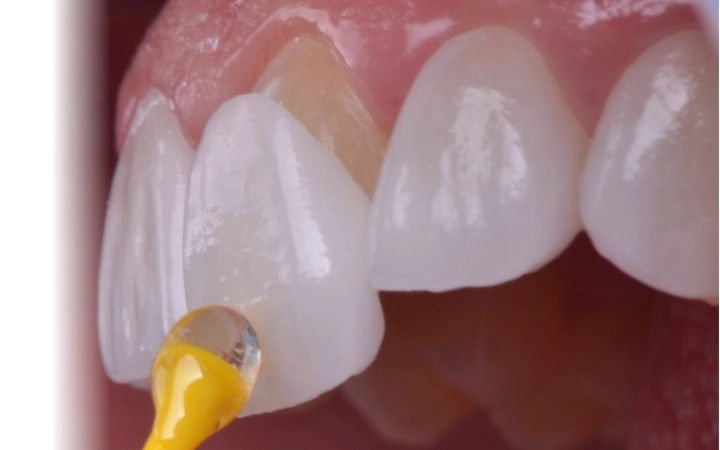 implant-operation  
