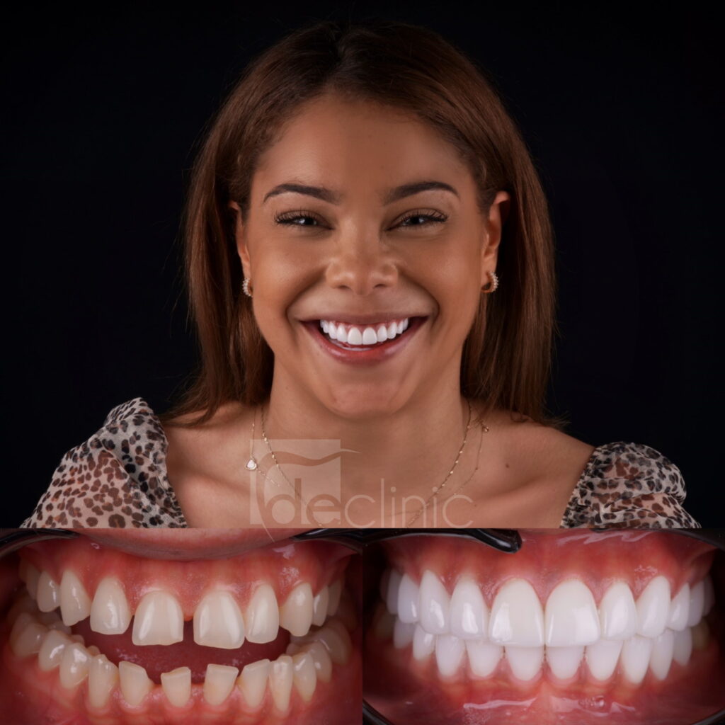 A patient’s laminate veneers before and after photos.