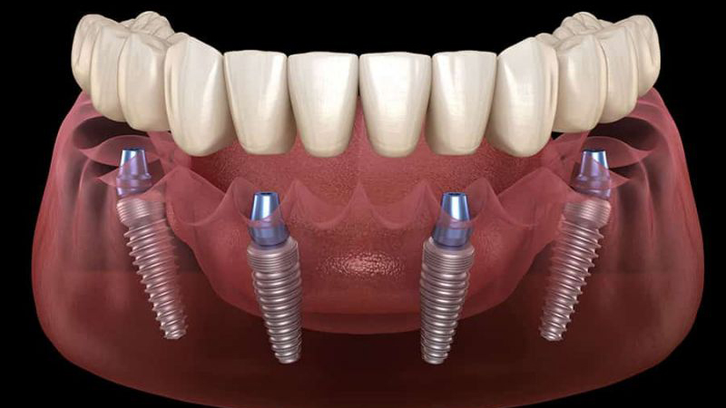 All on Four Implant Treatment in Turkey