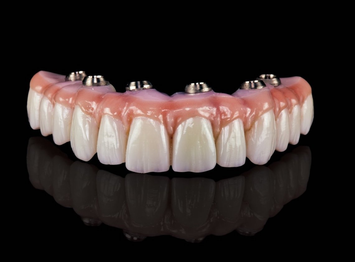 Имплантологическая кассета nobel полный набор для all on 4. Имплантация челюсти на 4 имплантах. Протез все на 4 х. Протез все на 4 х. Prettau bridge мостовидные протезы.