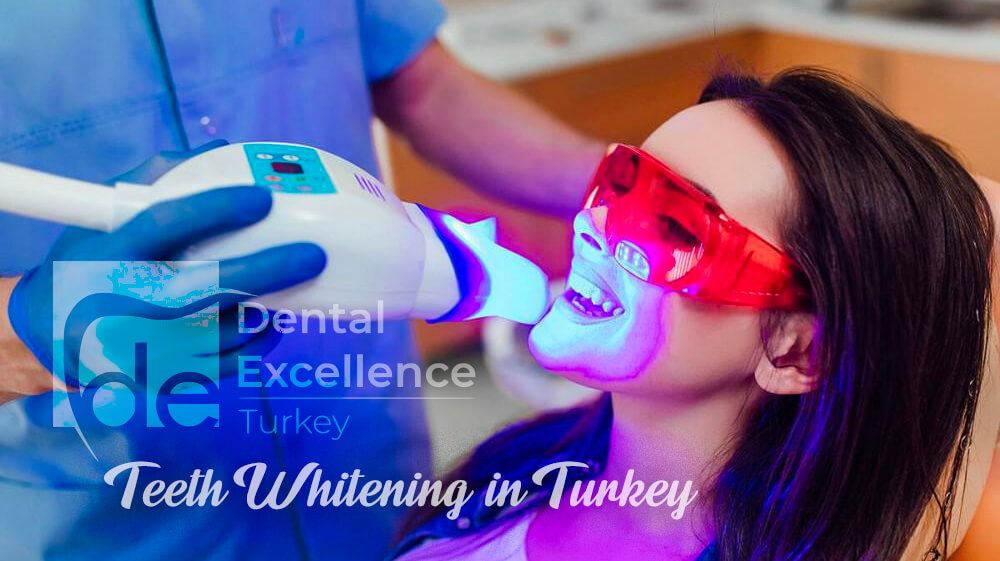 Teeth Whitening in Turkey, The Definitive Guide