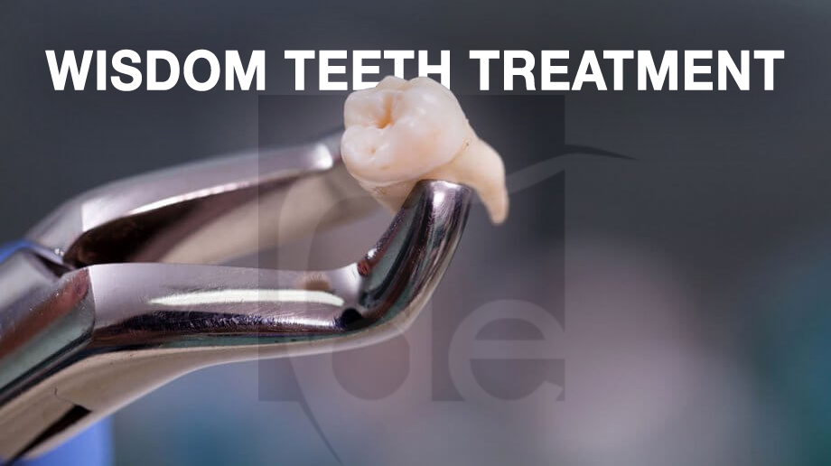 Everything You Need to Know About Wisdom Teeth Treatment in Turkey