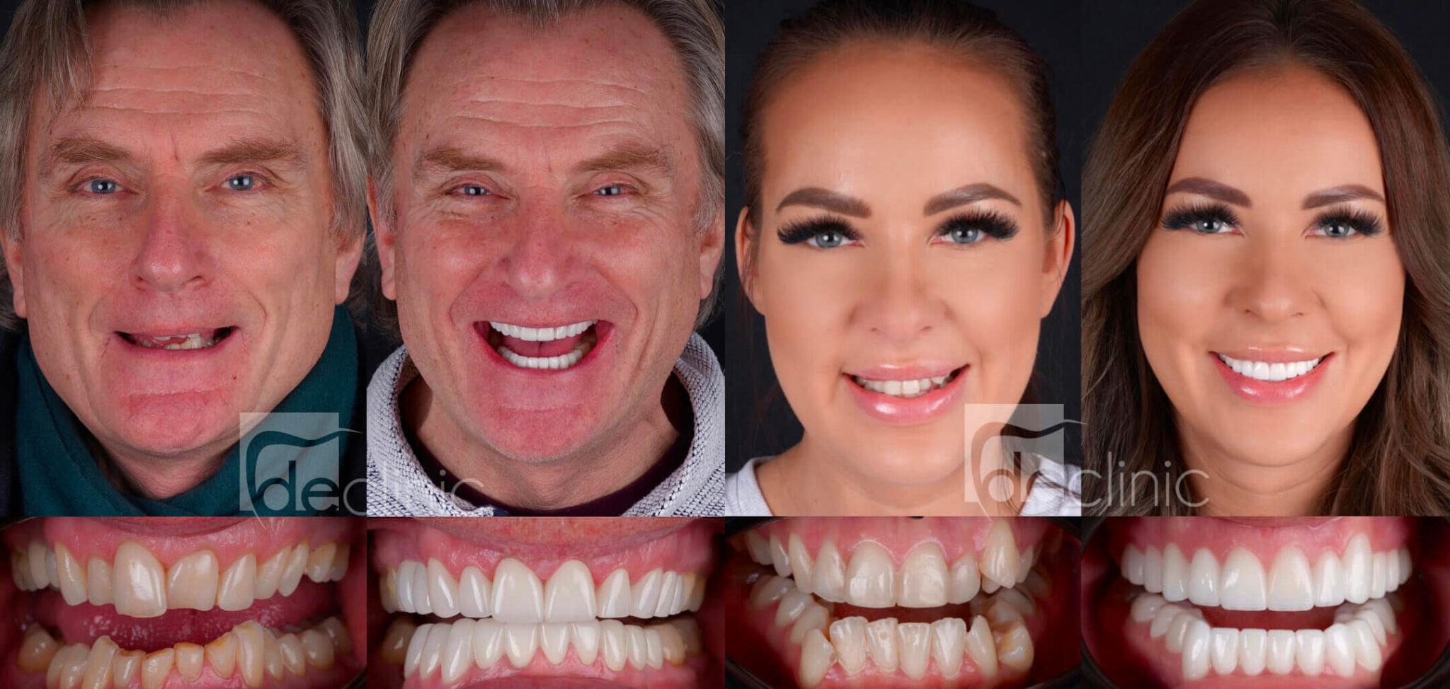 The Jewel in Your Smile All You Need to Know About Zirconium Crowns