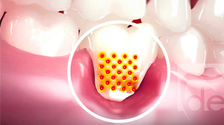 Gingival Recession Causes, Consequences, and Solutions