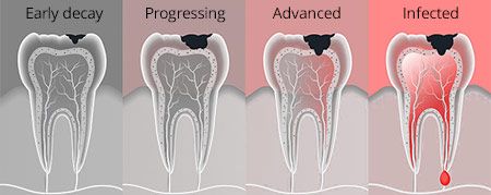 Tooth Decay Treated