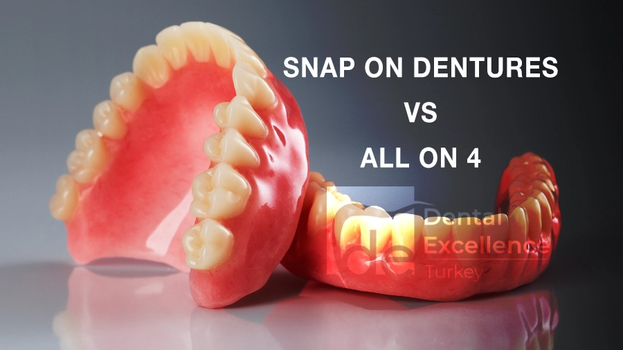 Snap on dentures vs all on 4