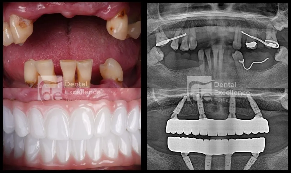 All on 4 dental implants in Turkey