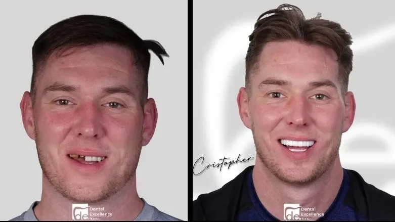 Can you get veneers with missing teeth?