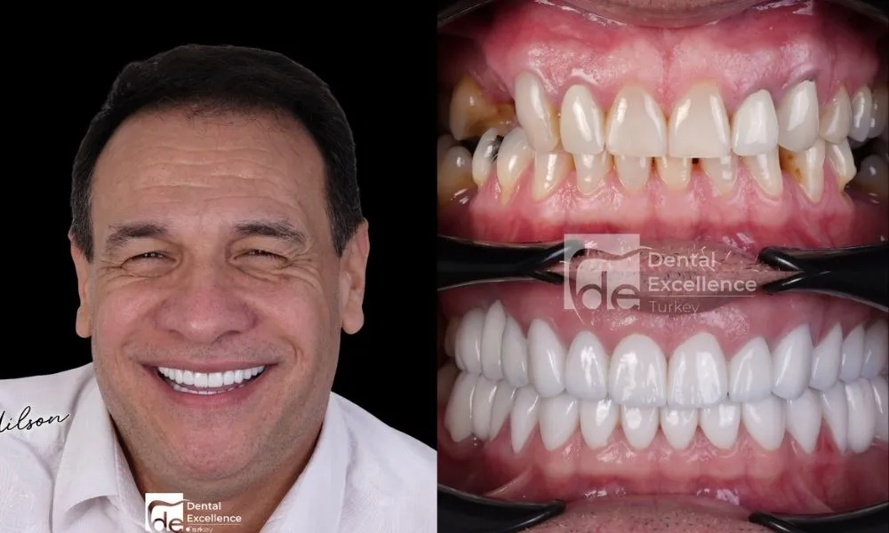 Dental crown in Antalya