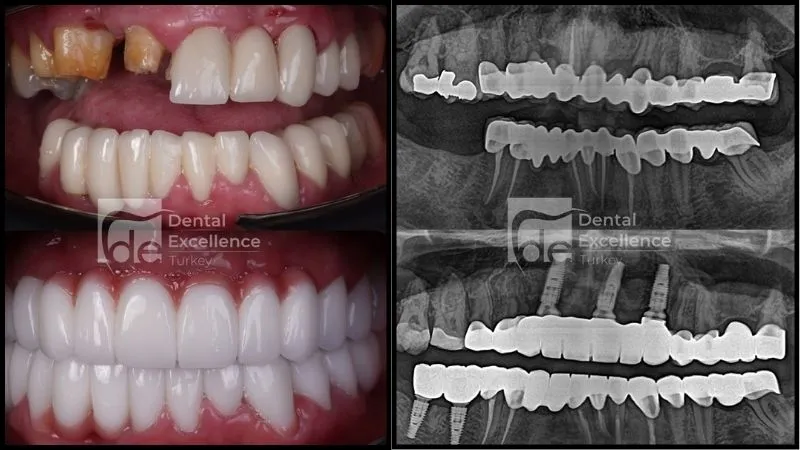 Dental implants for missing teeth in Antalya