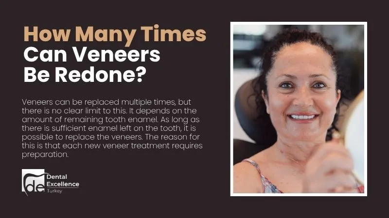 How Many Times Can Veneers Be Redone?