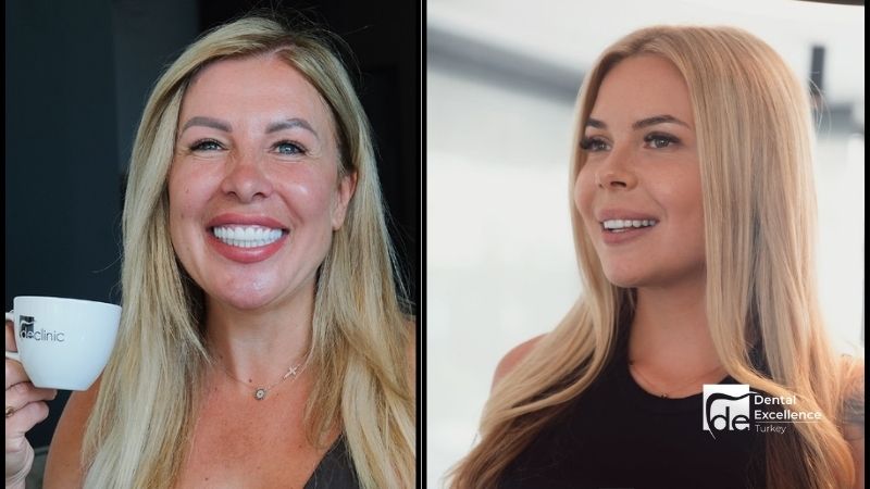 How Long Do Turkey Teeth Last?- Dental Excellence Turkey