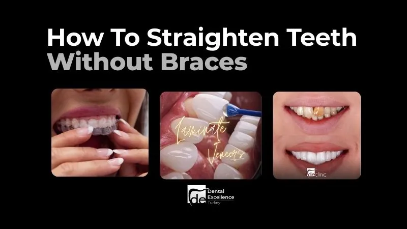 How To Straighten Teeth Without Braces