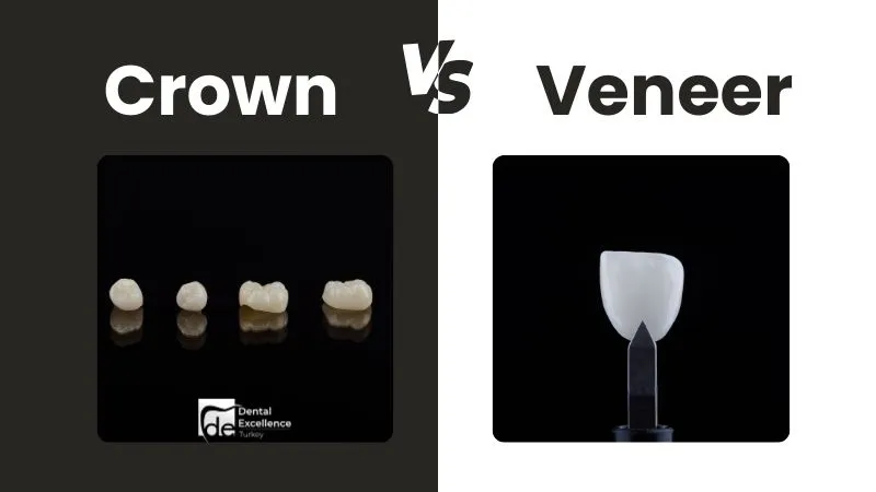 Crown vs Veneer: When Are They Used?