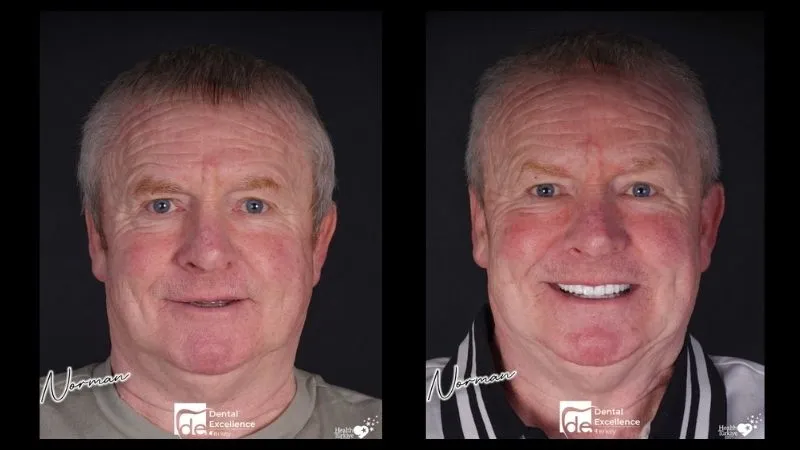 How much are All-on-4 dental implants in the UK vs Turkey?