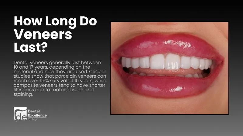 How long do veneers last?