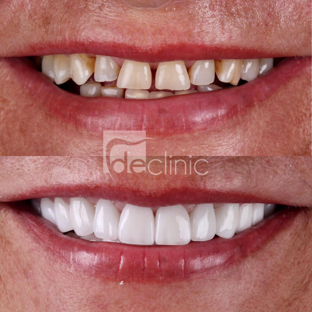 Couronne dentaire 50pcs, couronne dentaire dentale antérieure réaliste pour  soins dentaires temporaires avec 2 types de dents(Dents de devant)