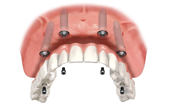 All on 4 dental implants in Turkey