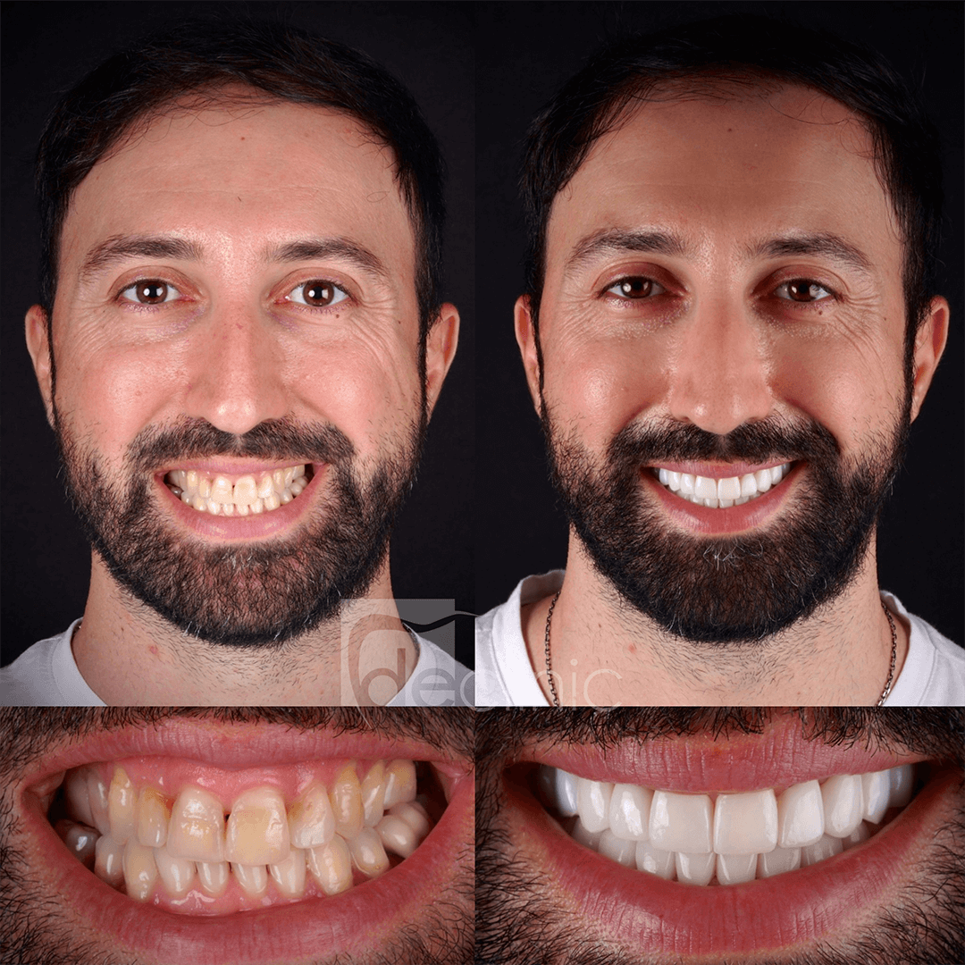 How to Achieve a More Aesthetic Smile: Contouring and Reshaping