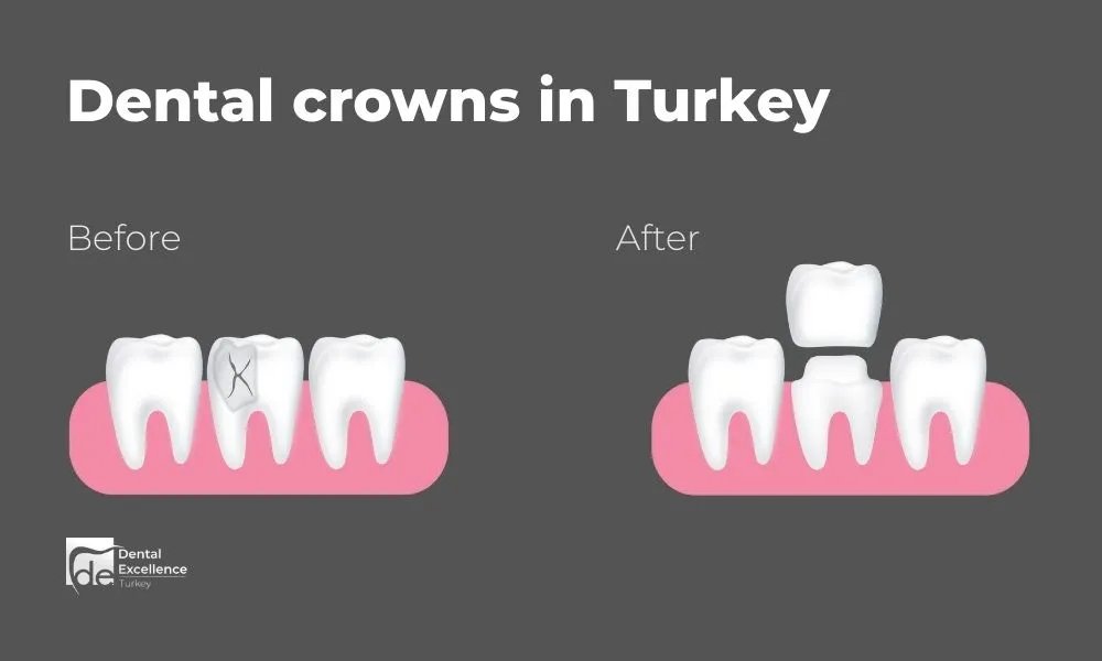 Dental crown in Turkey